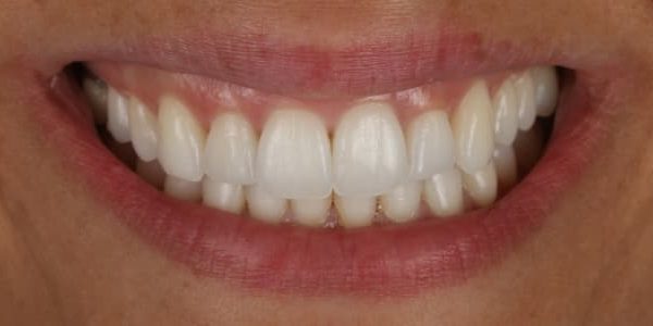 dientes amontonados y oscurecidos