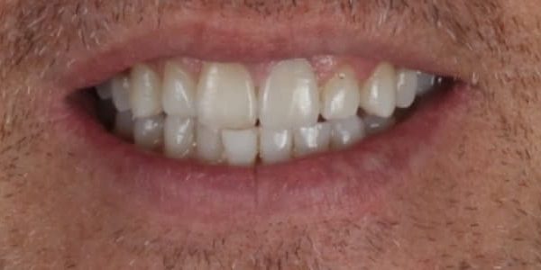 “Diente endodonciado fracturado” el nuevo caso LXXV que no te puedes perder.
