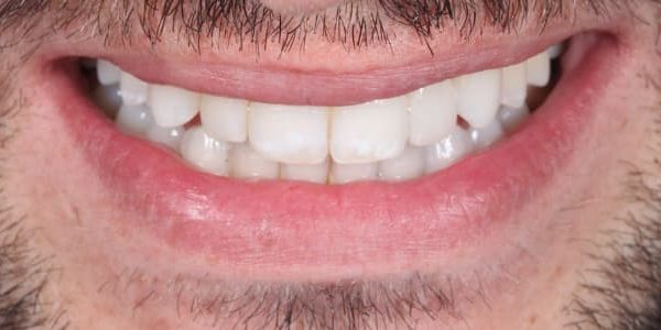 Tratamiento de ortodoncia invisible