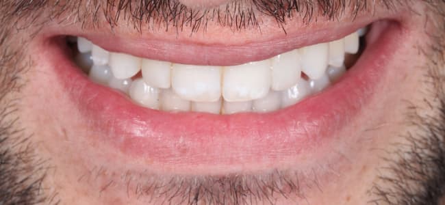 Tratamiento de ortodoncia invisible y dientes blancos