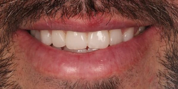 dientes que se rompen