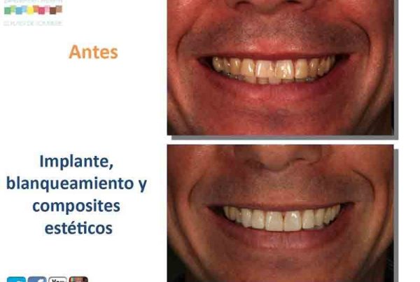 reponer un diente