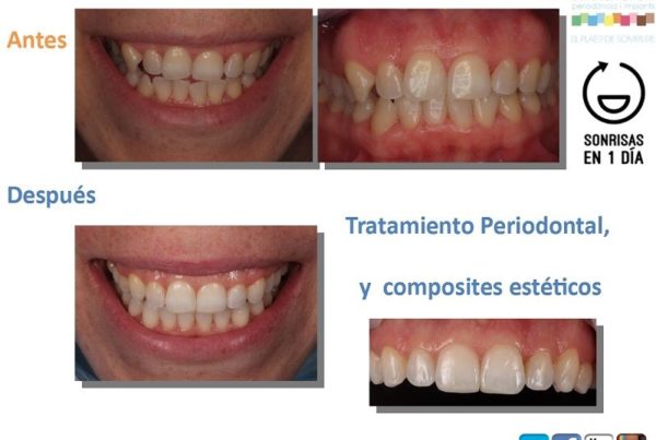 dientes no encajan