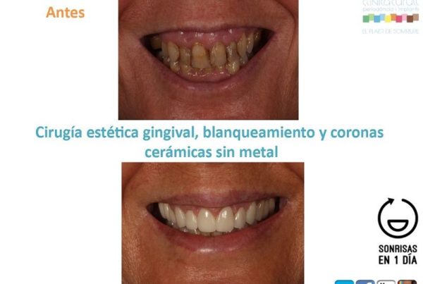 Dientes oscuros