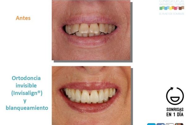 Dientes se desplazan hacia delante