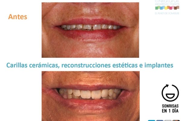dientes gastados y sensibles