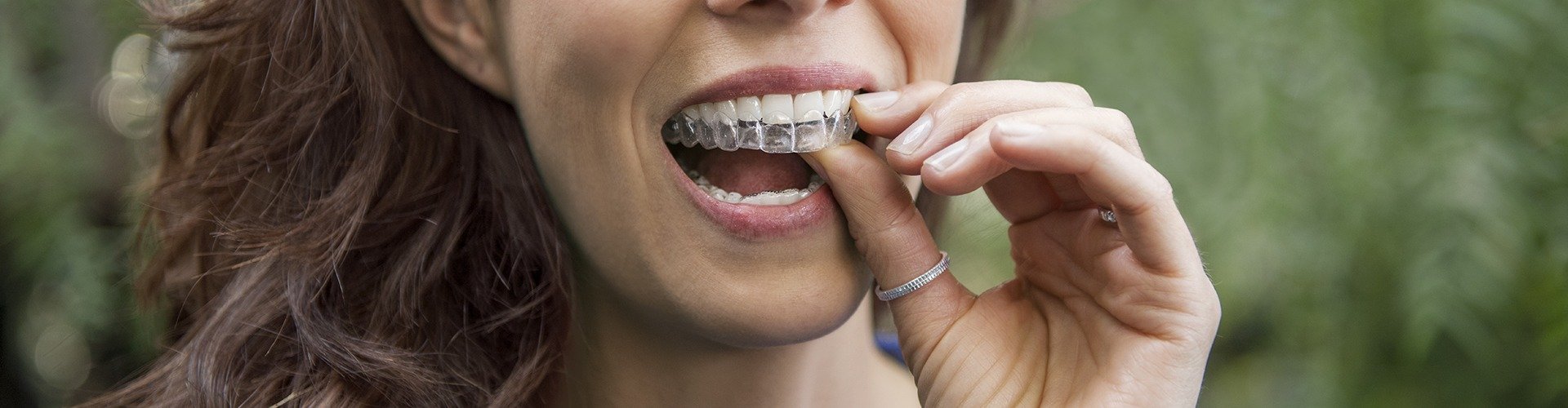 La importancia de tener los dientes bien alineados