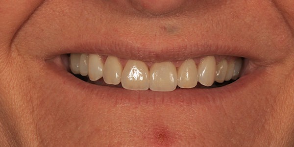 dientes cortos solución