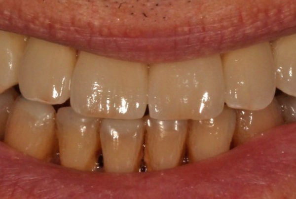 sensibilidad dental