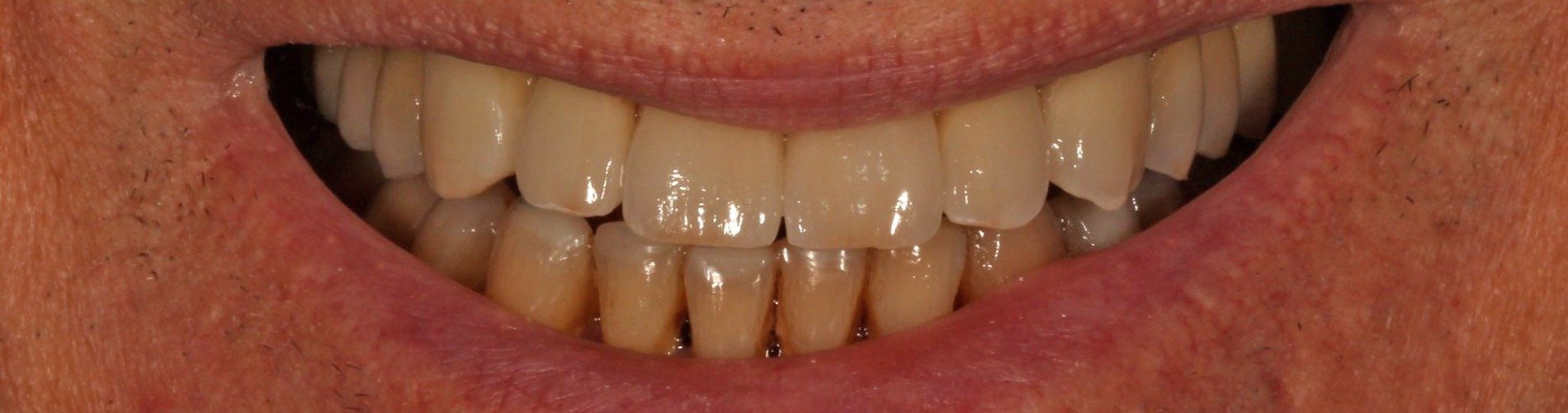 Dientes desgastados y sensibilidad dental