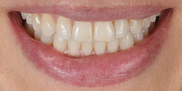 dientes desplazados despues curull