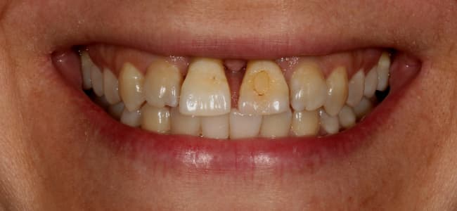 dientes-desplazados-delante-sonrisa-antes