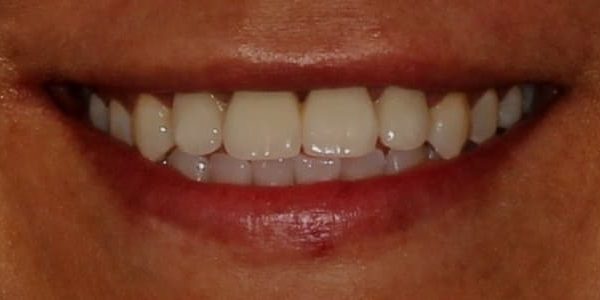 Dientes desplazados y separados