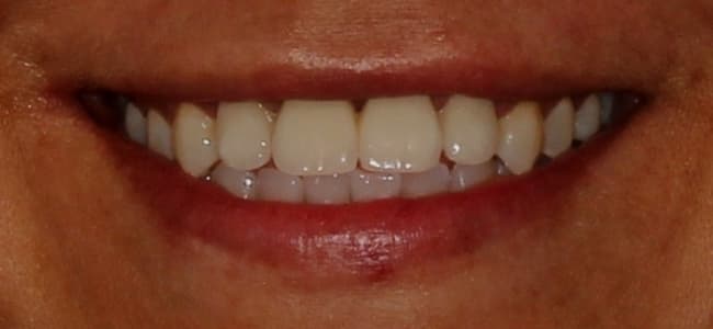 Dientes desplazados y separados