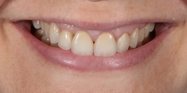 Problemas en el esmalte dental y coronas antiguas