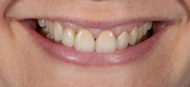 Problemas en el esmalte dental y coronas antiguas