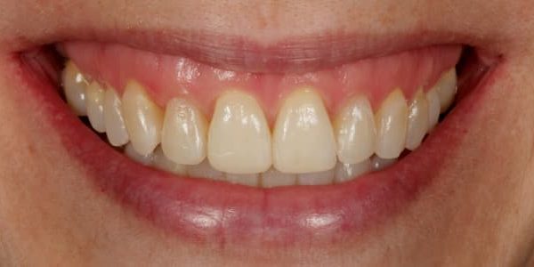 alinear mis dientes