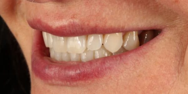 quiero renovar mi sonrisa