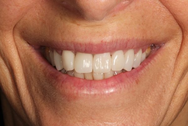 Cambio sonrisa despues