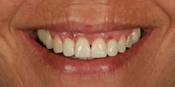 mis dientes se separan despues