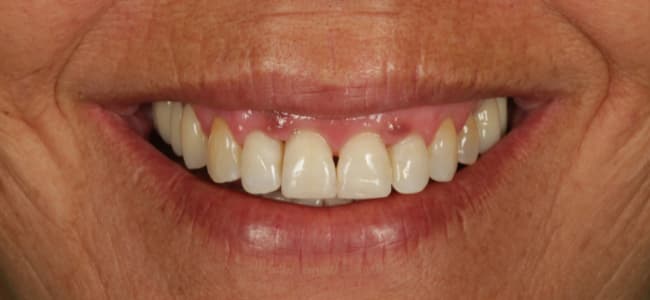 mis dientes se separan despues