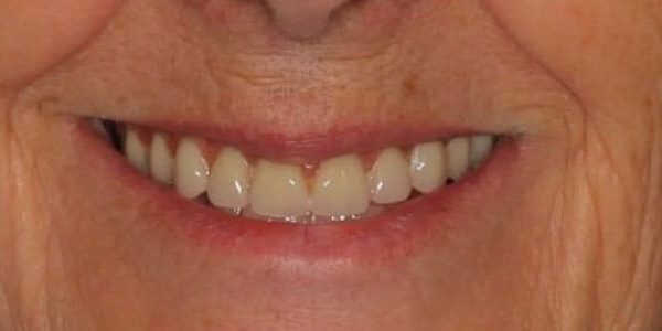 Aspecto envejecido por falta de dientes