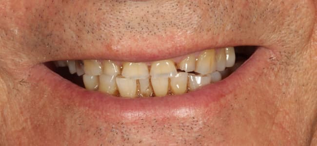 dientes que se romen e imposibilidad para comer bien antes