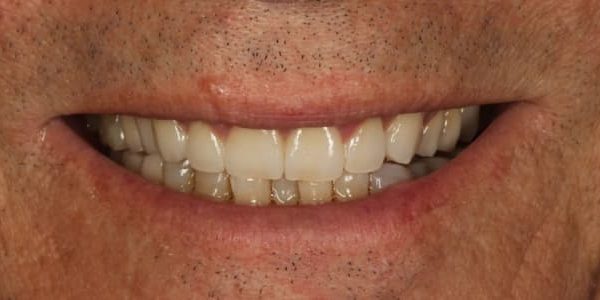 Dientes que se rompen e imposibilidad para comer bien