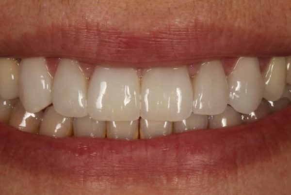 rejuvenecer sonrisa