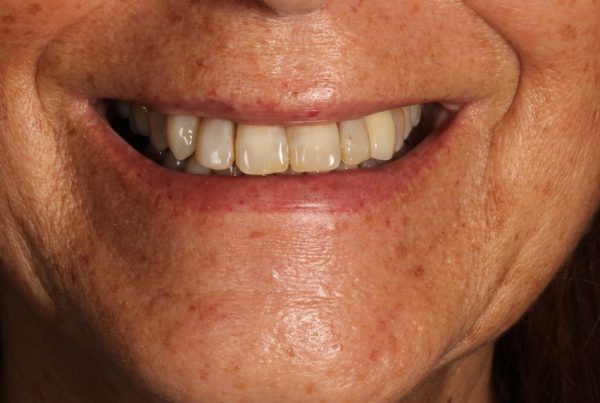 DISIMULAR LOS ESPACIOS NEGROS ENTRE LOS DIENTES DESPUÉS