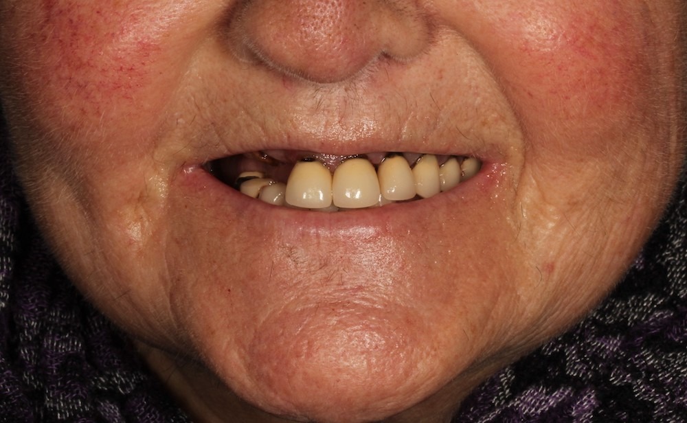 Antes sonrisa Misericordia