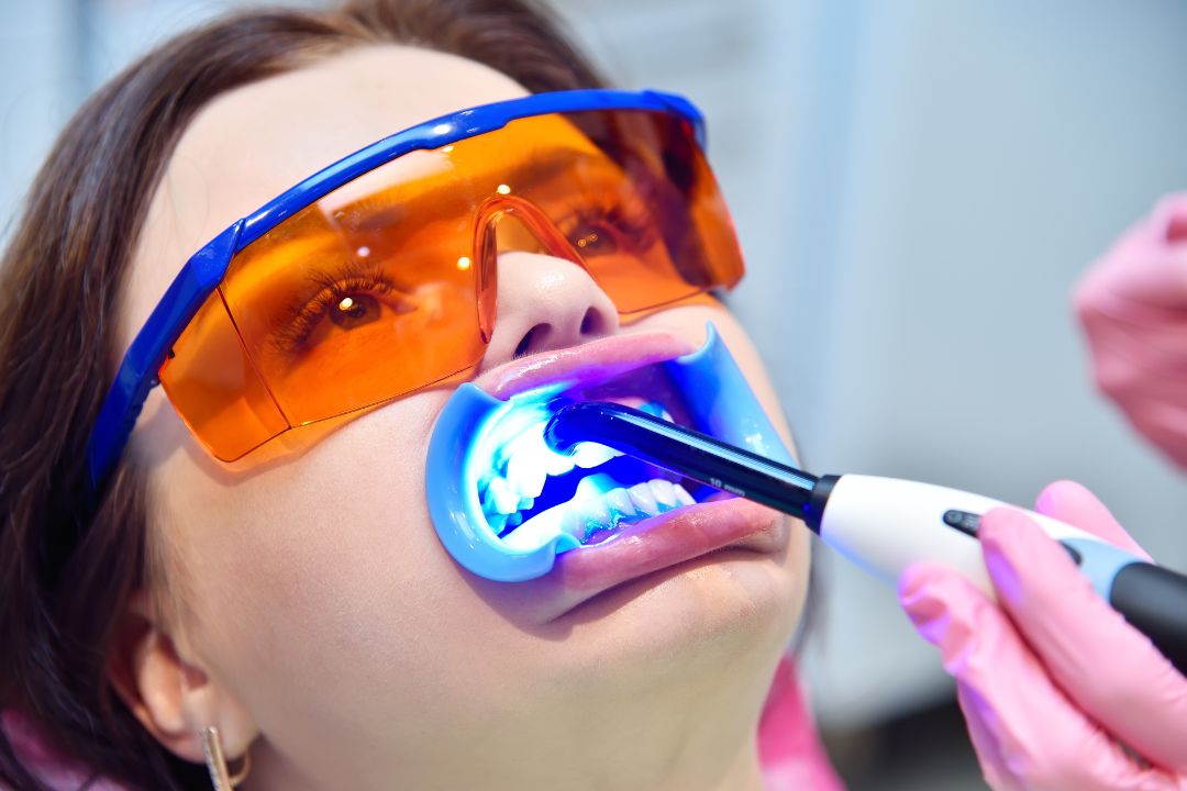 ¿Cuánto dura un blanqueamiento dental?