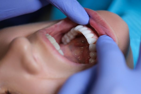 Diferencia entre carillas y fundas dentales