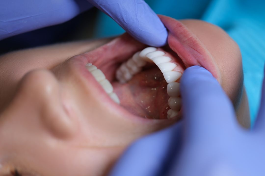 ¿Cuál es la diferencia entre carillas y fundas dentales?