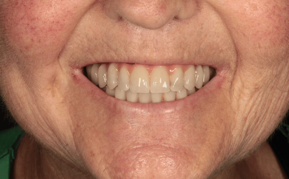 Llevo prótesis antiguas y no puedo comer bien