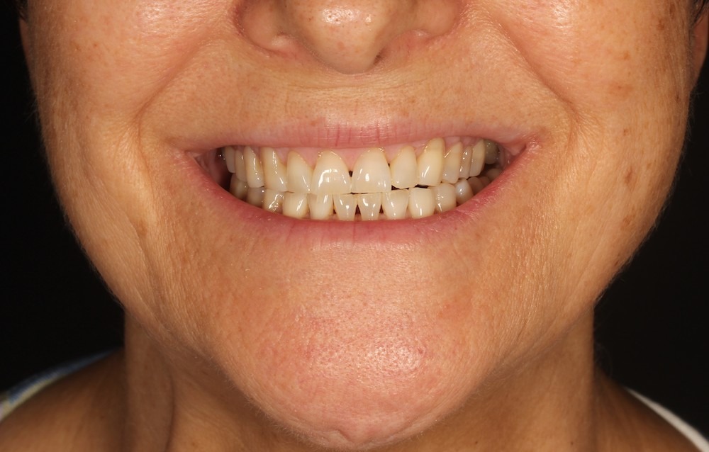 Me veo el diente cada vez más largo y tengo sensibilidad