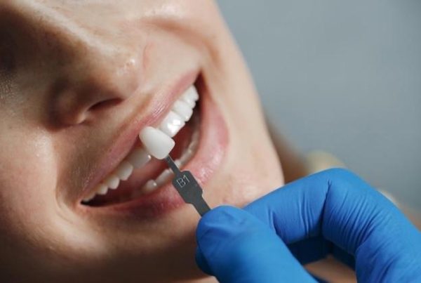 Tipos de carillas dentales