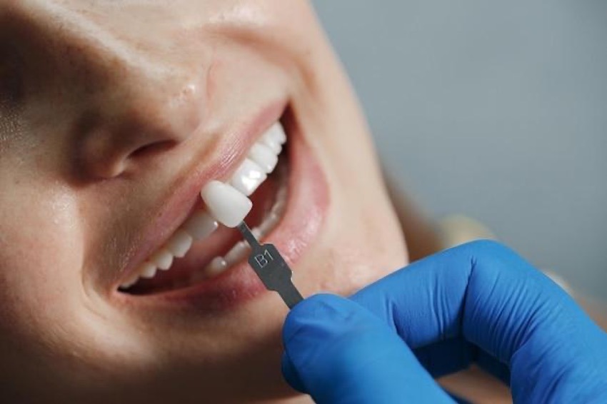 Tipos de carillas dentales