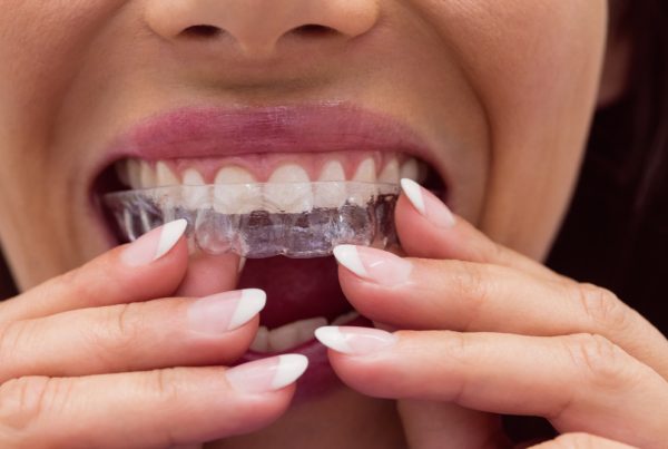 Corrección de mordida abierta con Invisalign®