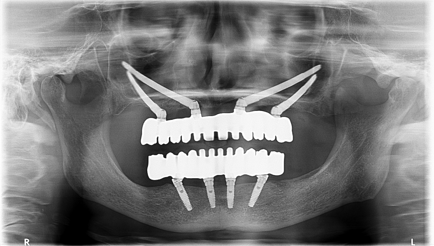 Implantes cigomáticos: la solución cuando no hay suficiente hueso maxilar