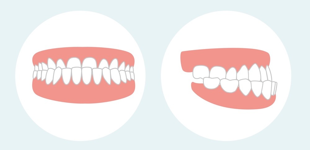 Mordida cruzada anterior