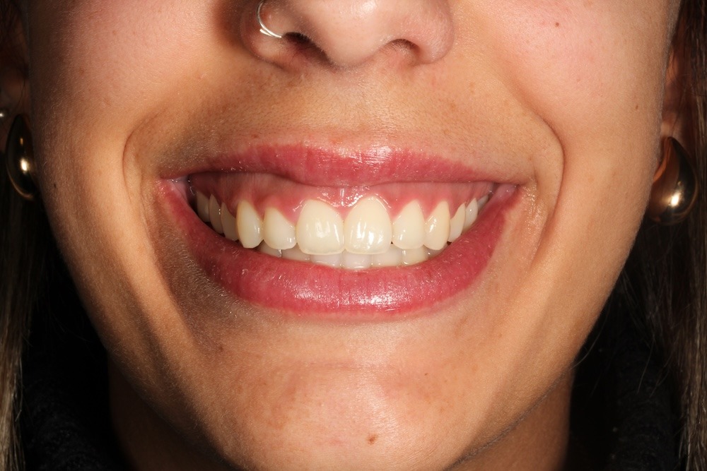 erupcion pasiva alterada antes