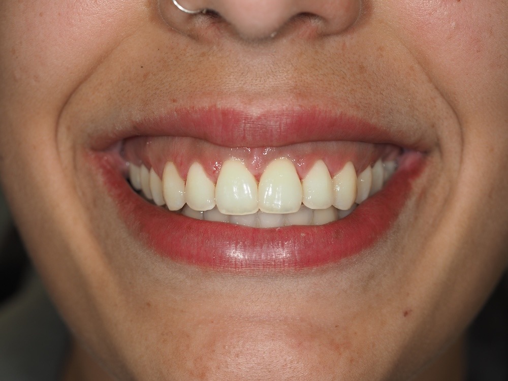 erupcion pasiva alterada despues