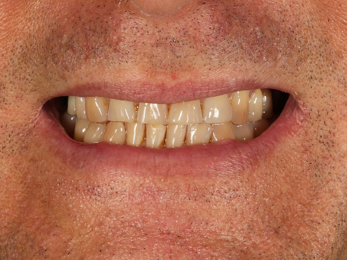 Detalle de la sonrisa antes del tratamiento de ortodoncia invisible en Clínica Curull Tarragona — caso real de Álvaro