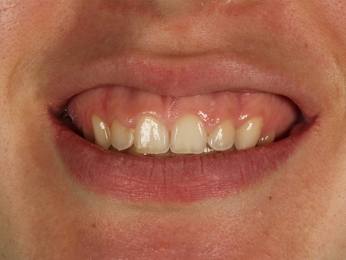 Detalle de la sonrisa antes del tratamiento de sonrisa gingival en Clínica Curull Tarragona — caso real de Ana