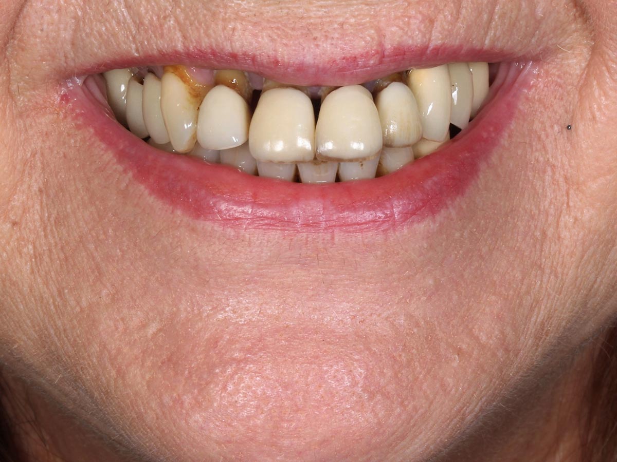 Resultado de la rehabilitación dental con DSD en Clínica Curull Tarragona — caso real de Ángeles
