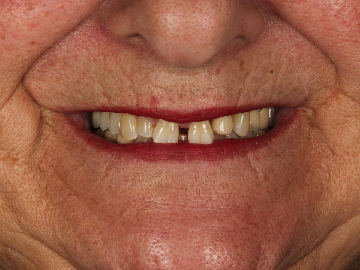 Detalle de la sonrisa antes de la rehabilitación dental en Clínica Curull Tarragona — caso real de Cinta