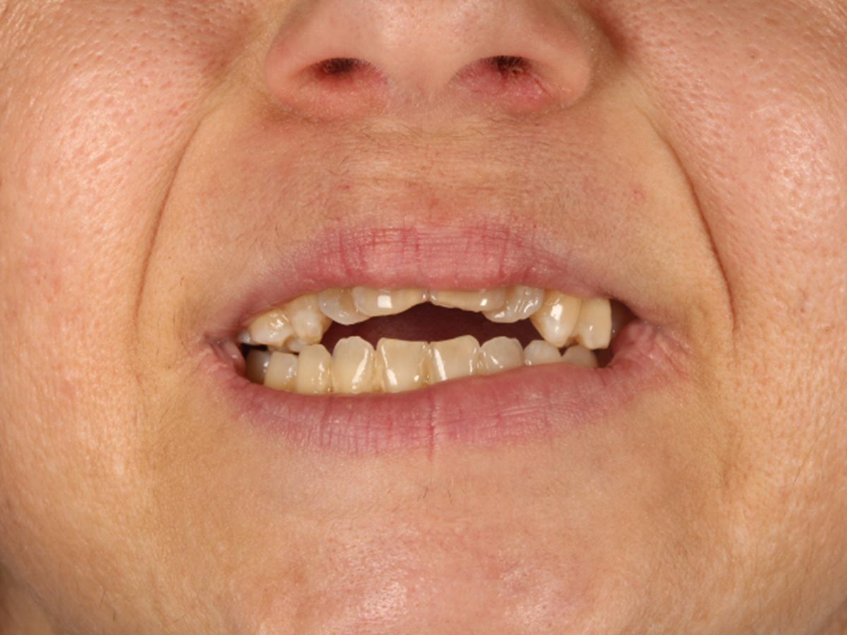 Detalle de la sonrisa antes del tratamiento de implantes dentales superiores en Clínica Curull Tarragona — caso real de Elena