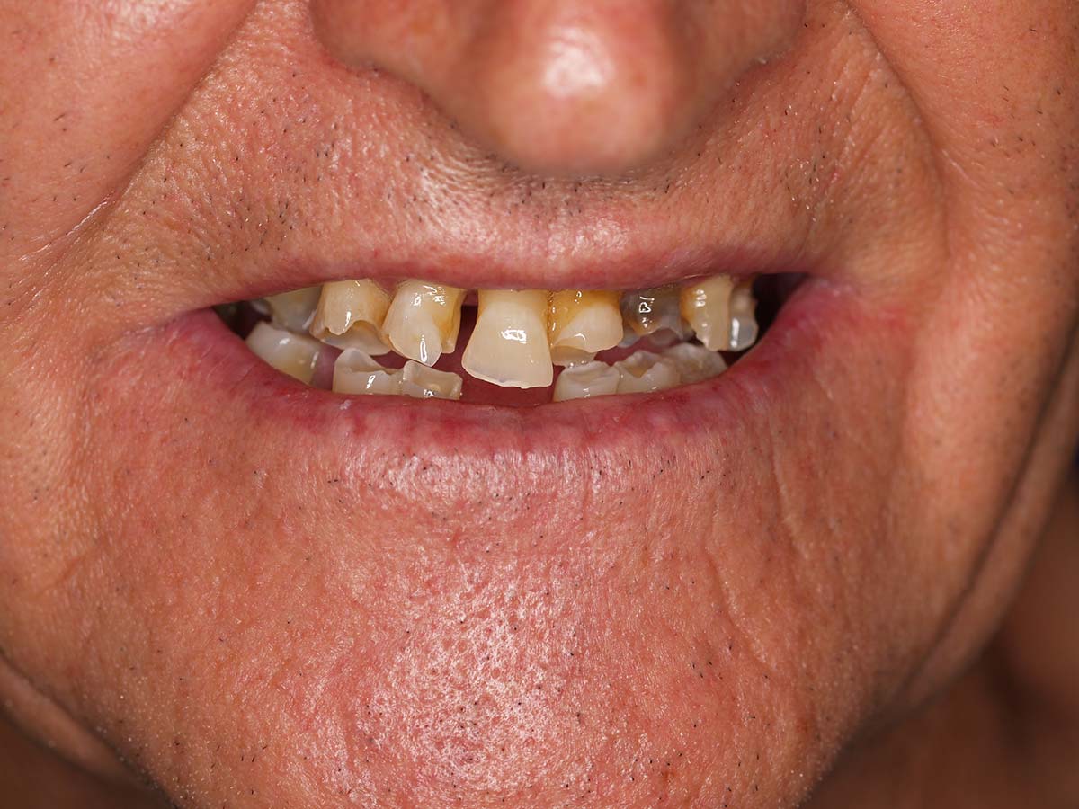 Detalle de la sonrisa antes del tratamiento de EXTRACCIONES · IMPLANTES AMBAS ARCADAS · PRÓTESIS FIJA EL MISMO DÍA en Clínica Curull Tarragona — caso real de Josep