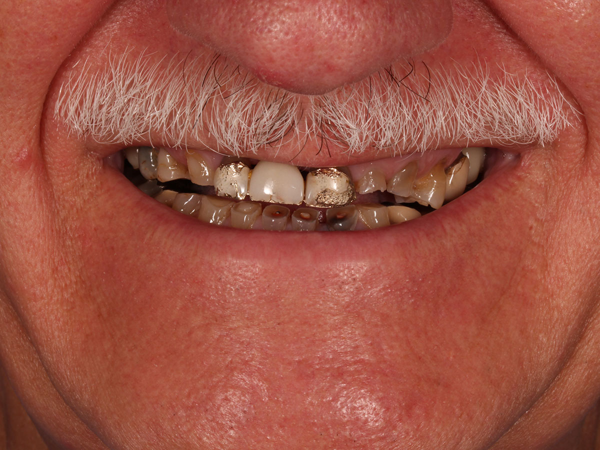 Detalle de la sonrisa antes del tratamiento de implantes en Clínica Curull Tarragona — caso real de Martín Morales